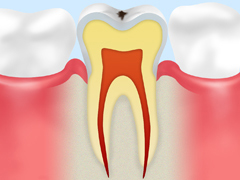 CO初期段階の虫歯