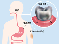 金属アレルギーの原因物質