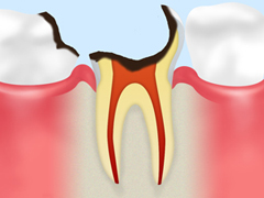 C3神経に達した虫歯