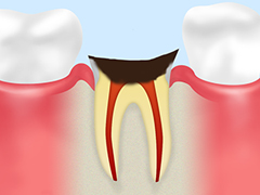 C4歯根に達した虫歯